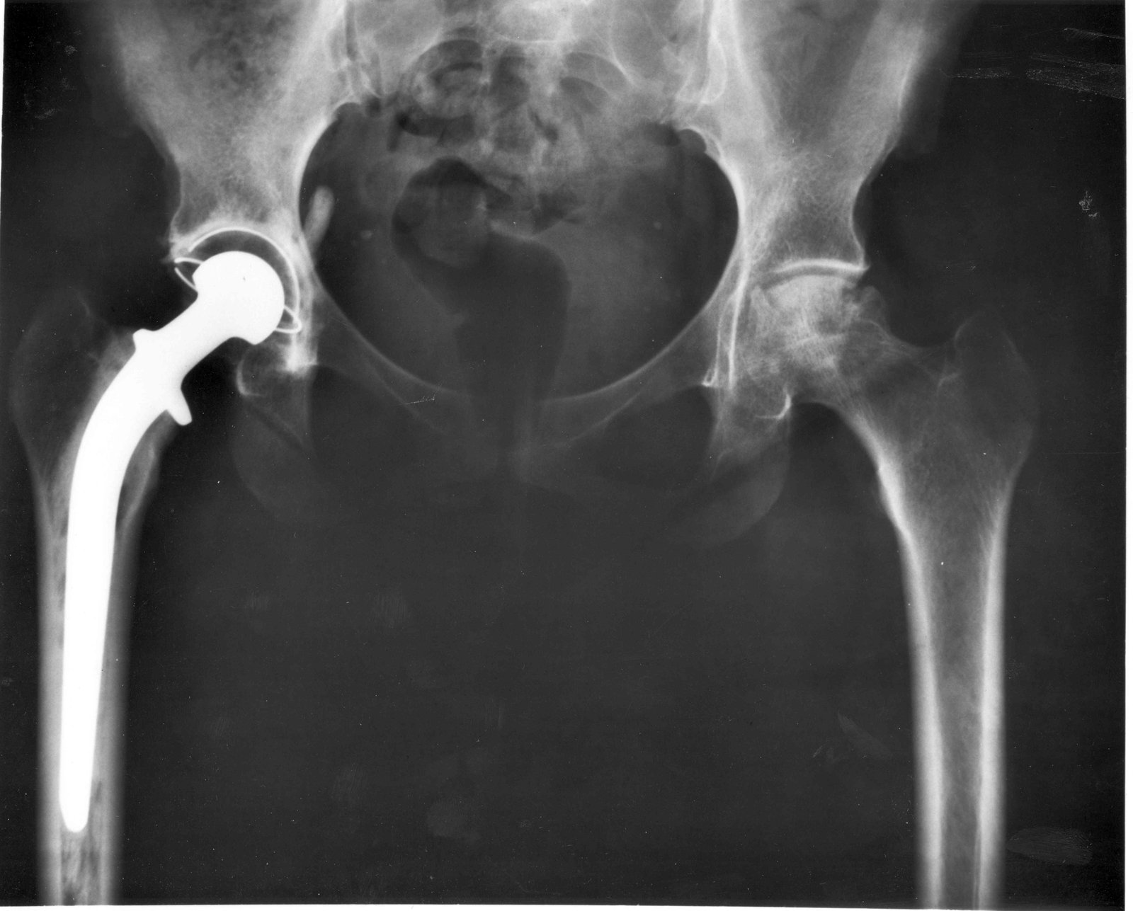 X-ray comparing a total hip replacement to a natural hip joint